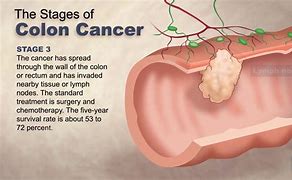 Image result for Stage 4 Cancer Meaning