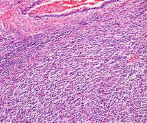Image result for Pic of Stage 1 Melanoma