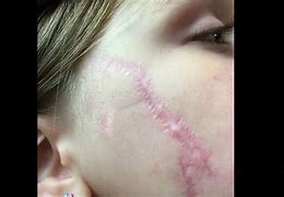 Image result for Surgery Scars Healing