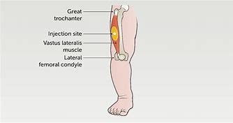 Image result for Intramuscular Injection Sites for Adults