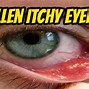 Image result for Woke Up with Swollen Under Eye