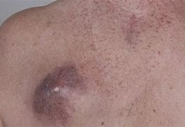 Image result for Stage 4 Melanoma Cancer On Face