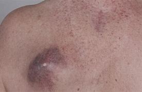 Image result for Stage 4 Melanoma Treatment