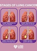 Image result for Stage 4 Lung Cancer Bokiun Pills