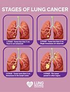 Image result for Early Stage Lung Cancer Prognosis