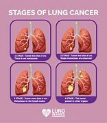 Image result for Stage 3 Lung Cancer Scan