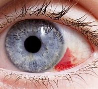 Image result for Eye Filled with Blood