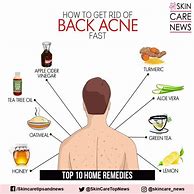 Image result for Back Acne Treatment