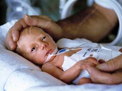 Image result for Newborn Premature Babies