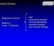 Image result for Kawasaki Disease Mnemonic