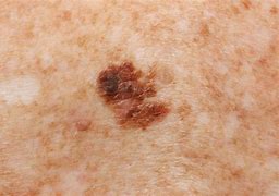 Image result for Stages of Melanoma