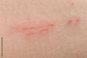 Image result for Fingernail Scratches On Skin