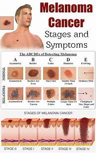 Image result for First Stage Melanoma
