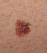 Image result for Superficial Spreading Melanoma