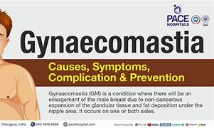 Image result for Gynecomastia Symptoms