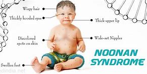 Image result for Noonan Syndrome