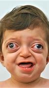 Image result for Mild Crouzon Syndrome