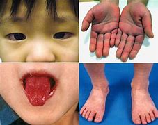 Image result for AAFP Kawasaki Disease