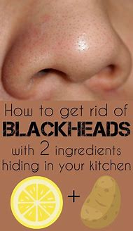 Image result for The Best Way to Get Rid of Blackheads