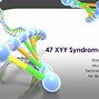 Image result for Recognizable Features of XYY Syndrome