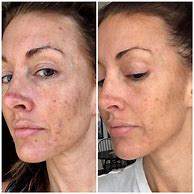 Image result for Arbonne RE9 Before and After