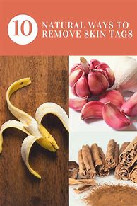 Image result for How Remove Skin Tags Naturally