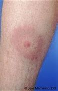 Image result for Lyme Disease On Black Skin