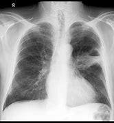 Image result for Stage 4 Lung Cancer X-ray