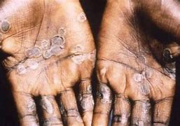 Image result for Severe Smallpox