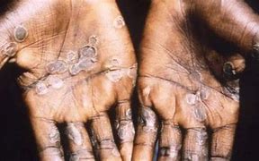 Image result for Monkeypox On Skin