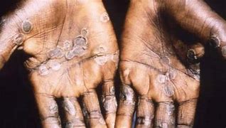 Image result for Smallpox Pustules