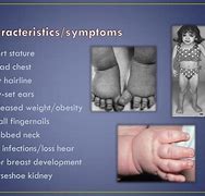 Image result for Turner Syndrome Features