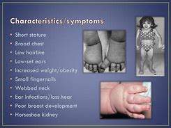 Image result for What Would Show with Turner Syndrome Symptoms