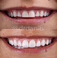 Image result for Teeth Porcelain Veneers Before and After