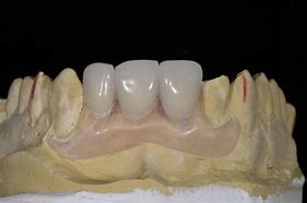 Image result for Flipper Dental Mandibular