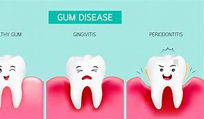 Image result for Gingivitis Gum Recession