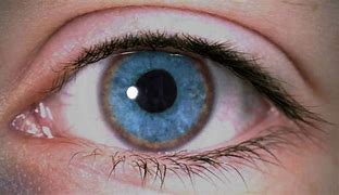 Image result for Wilson's Disease