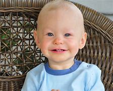 Image result for Williams Syndrome Baby
