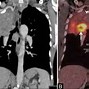 Image result for Lung Cancer On Pet Scan