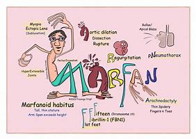 Image result for Marfan Syndrome Features