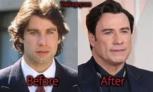 Image result for John Travolta Surgery