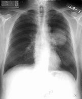 Image result for Small Cell Lung Cancer Large Mass