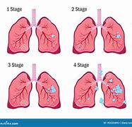 Image result for Stage Four Lung Cancer Symptoms