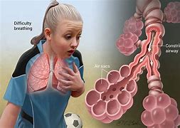 Image result for Patient with Asthma