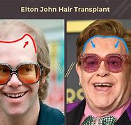 Image result for Elton John Hair Transplant or Wig