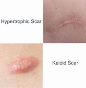 Image result for Hypertrophic Scar Treatment