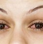 Image result for Bacterial Pink Eye