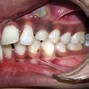 Image result for Orthodontics Removable Appliances with Single Cantilever