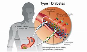 Image result for Diabetes Mellitus Type 2