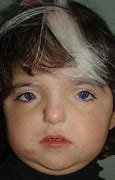 Image result for Chinese Waardenburg Syndrome